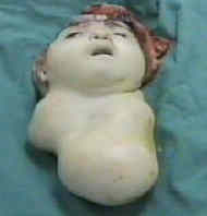 The Excised Head